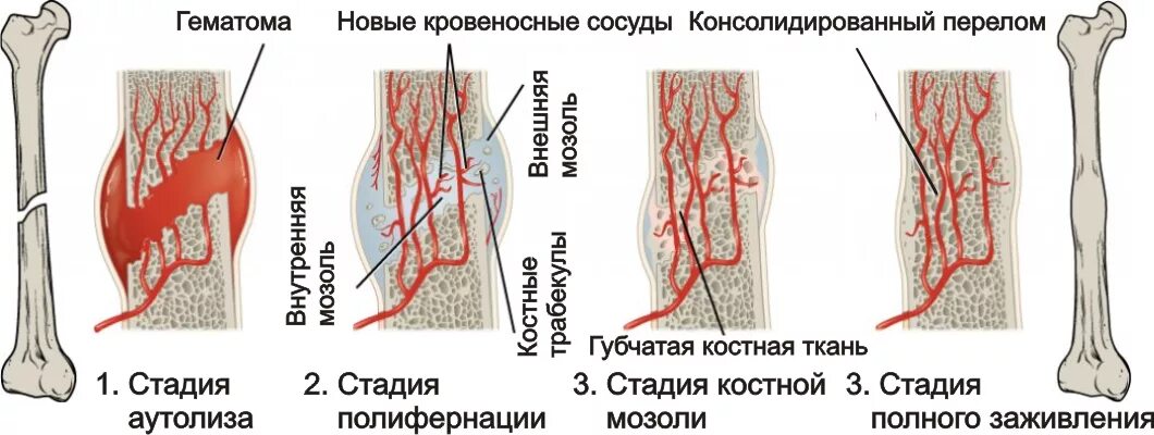 Трещина заживает. Стадии формирования костной мозоли. Фазы формирования костной мозоли. Этапы заживления перелома кости. Заживление перелома 4 стадии.