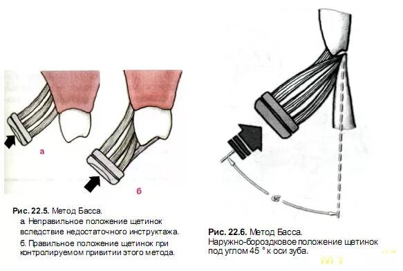 Метод басса чистка. Методы чистки зубов метод басса. Метод басс чистки зубов. Методика Bass чистка зубов.