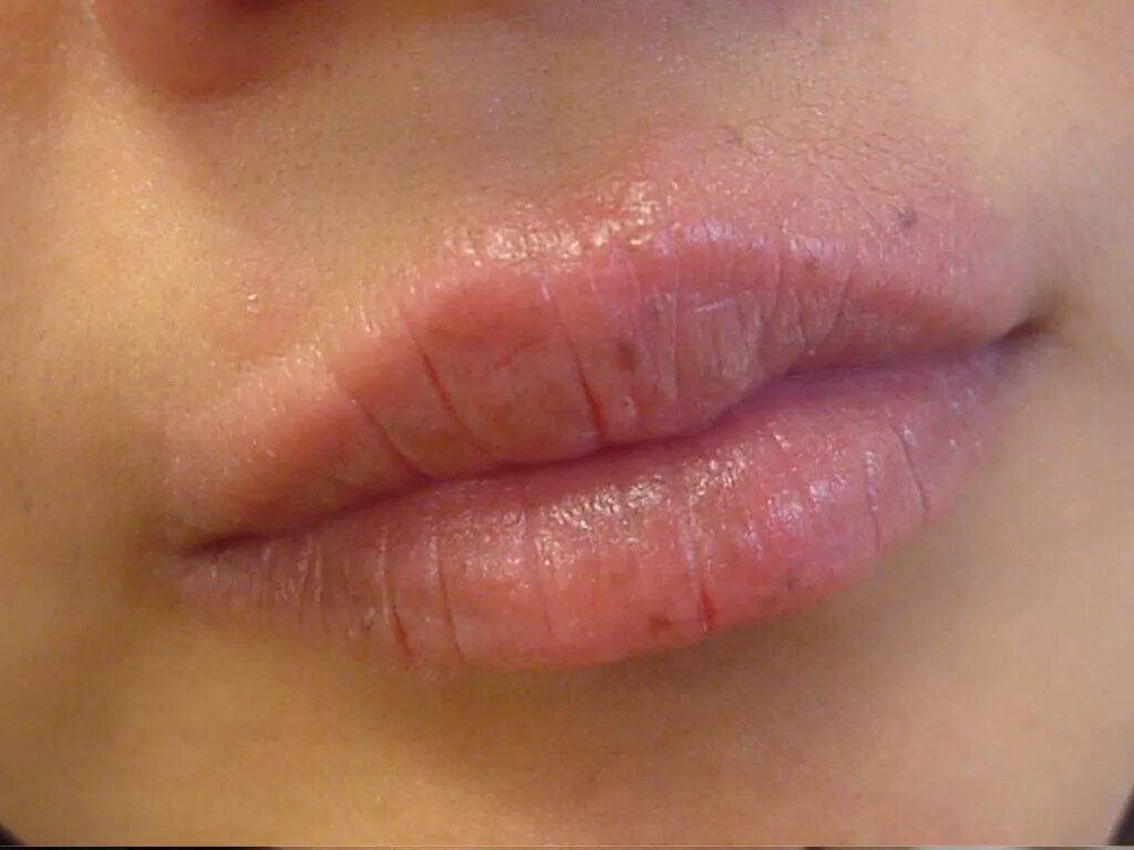 Красное пятно на верхней губе. Периоральный дерматит околоротовой. От поцелуя раздражение. Розацеаподобный периоральный дерматит. Поцелуй фото.
