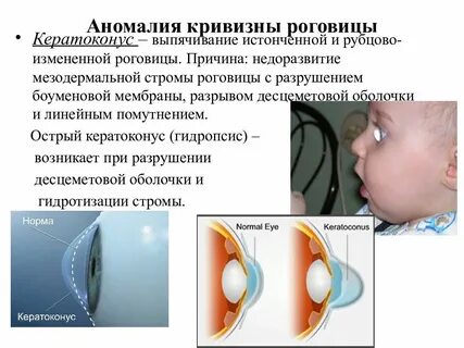 Аномалия роговицы