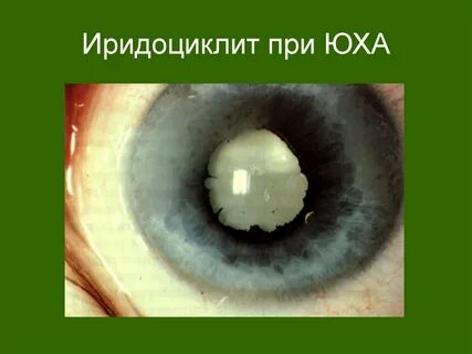 Острый приступ иридоциклита