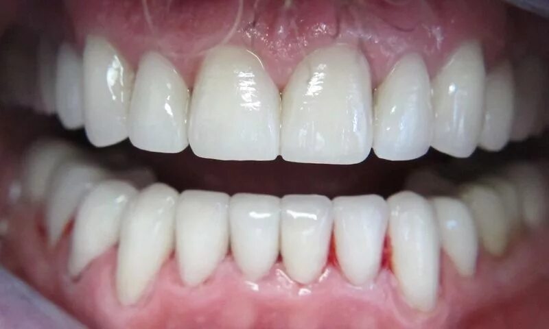 Диоксид циркония виниры блич. Виниры из циркония. Безметалловая керамическая коронка е. Виниры цельнокерамические emax. Виниры из диоксида циркона.