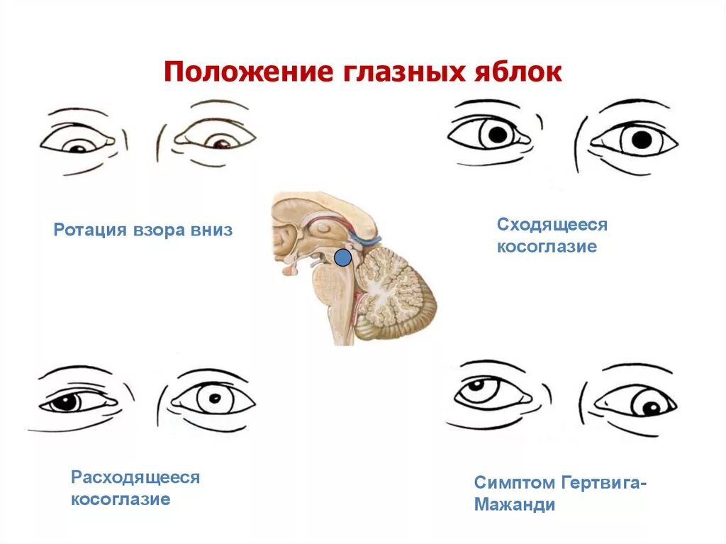 Нарушение движения глаз. Синдром Гертвига Мажанди. Положение глазного яблока. Исследование объема движений глазных яблок.