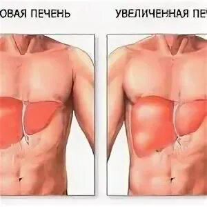 Левая печень увеличена. Симптомы увеличенной печени. Гепатомегалия печени опухоли.