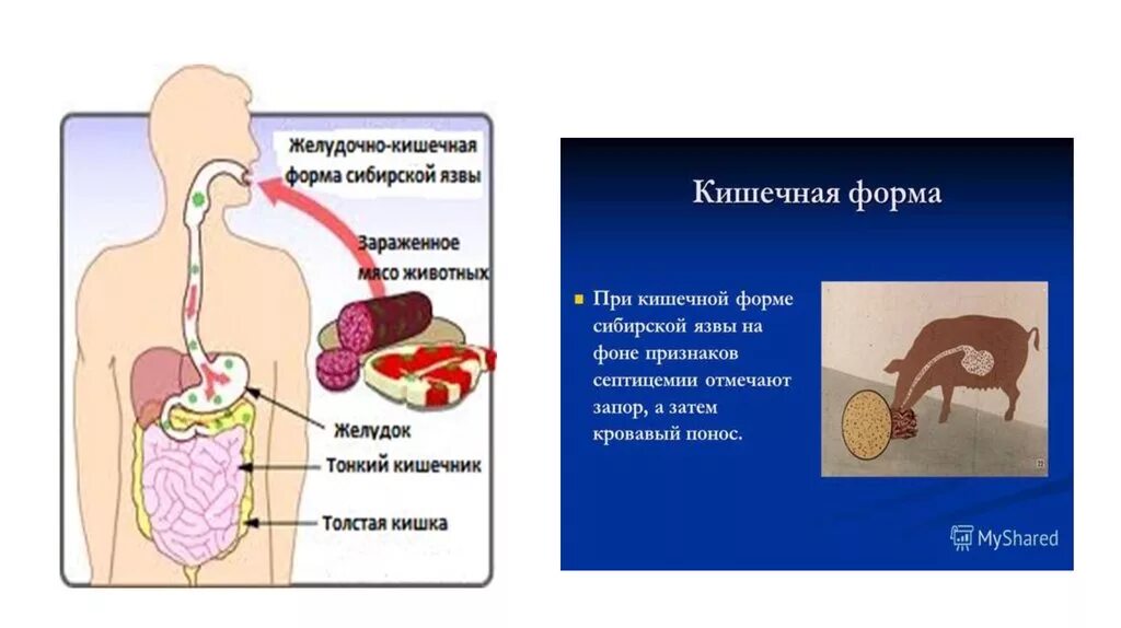 Желудочно кишечная форма сибирской язвы. Сибирская язва легочная форма симптомы. Лешлчнся форма сибирсеой язвы. Легочная и кишечная форма сибирской язвы. Как передается язва