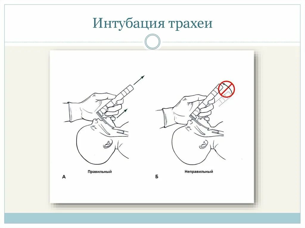 Техника интубации трахеи новорожденному. Интубация новорожденных алгоритм. Эндотрахеальая интубабация новорожденного. Ларингоскопия при интубации. Осложнения трахеи