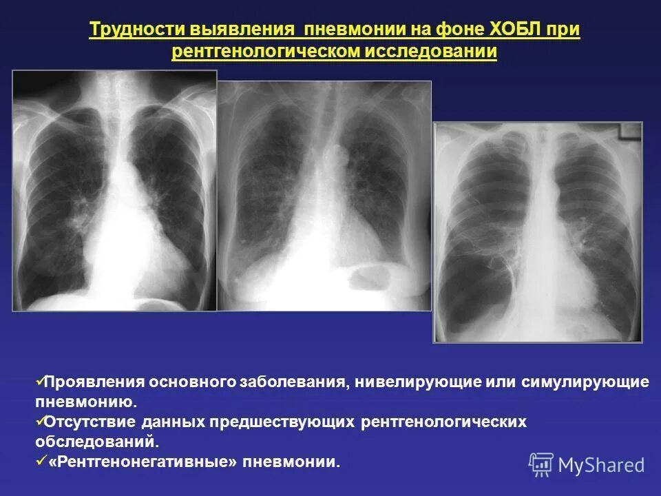 Описание снимков рентгена легких