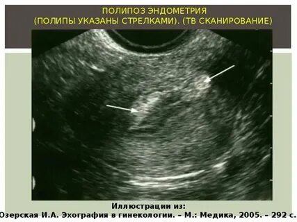 После удаления полипа матки можно забеременеть
