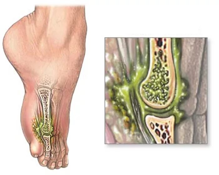 Остеомиелит – воспаление кости и костного мозга.. Острый Гнойный остеомиелит. Экстрамедуллярный остеомиелит. Гнойные заболевания суставов