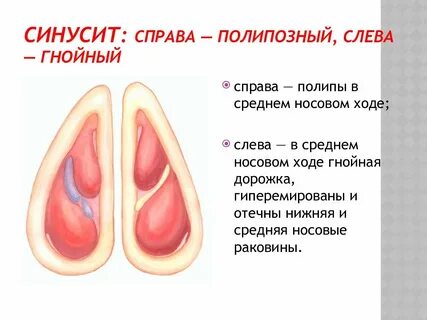 Полипозный гайморит