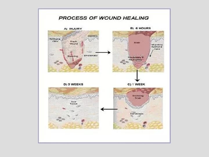 Через сколько заживает рана. Вторая фаза заживления раны. Процесс заживления раны.