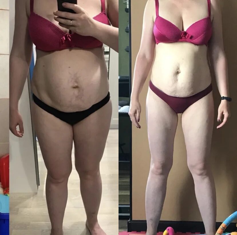 Живот до и после похудения. Похудение после родов.