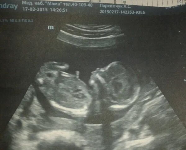 Двойняшки на узи 12 недель беременности. Узи 15 недель беременности двойня. Узи 11 недель беременности двойня. Узи двойни на 14 неделе беременности. 15 недель беременности двойней.