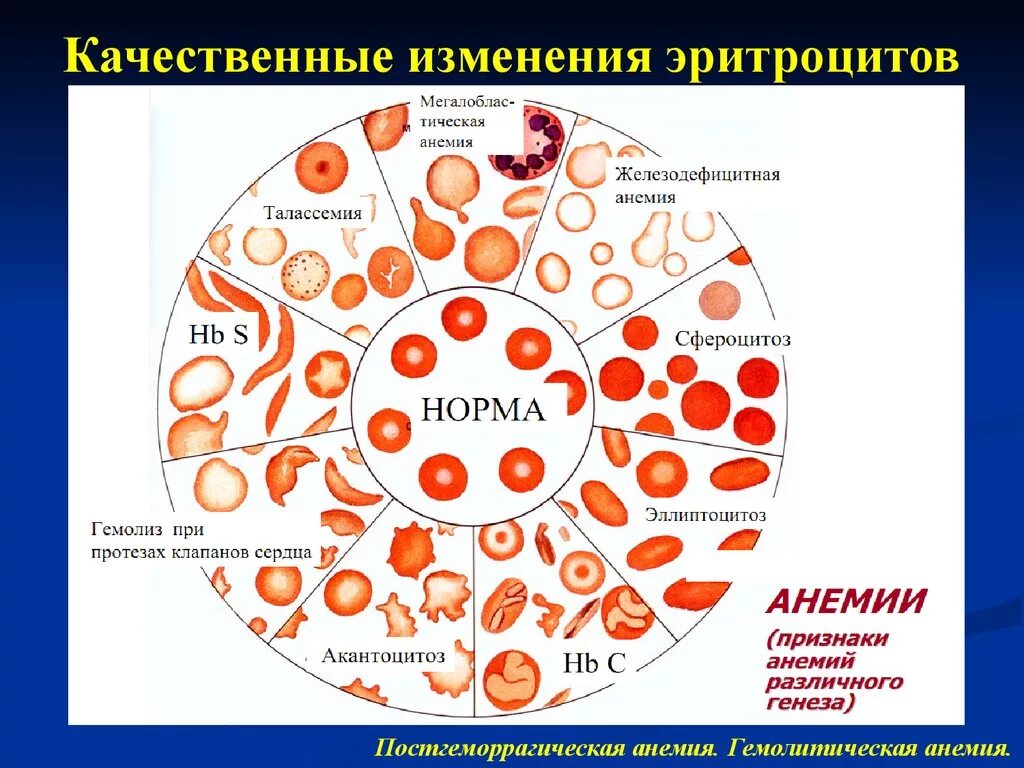 Малокровие вызвано. Изменения структуры эритроцитов при анемии. Анемия с изменением формы эритроцитов. Эритроциты при железодефицитной анемии у детей. Эритроциты при железодефицитной анемии.