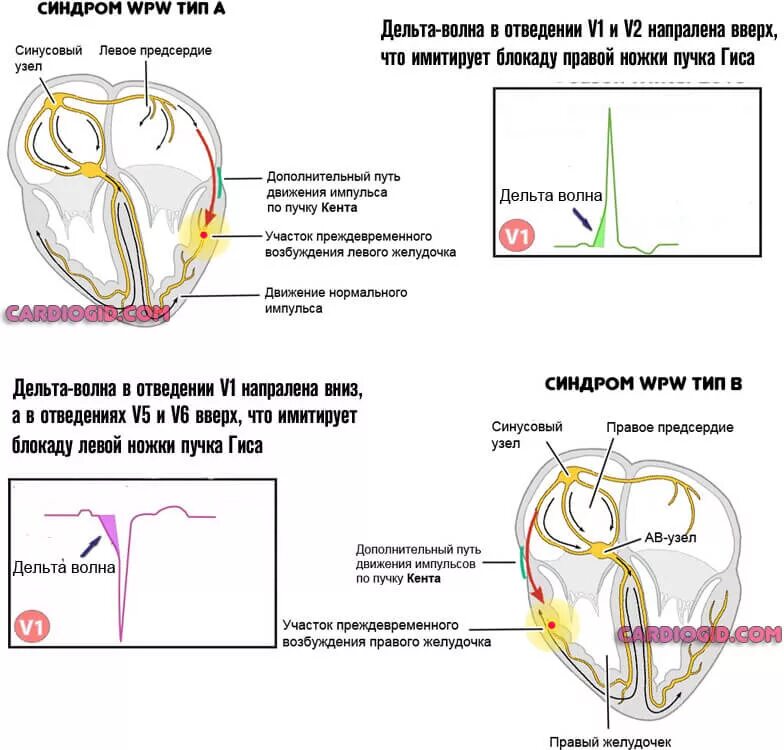 Синдром типа б