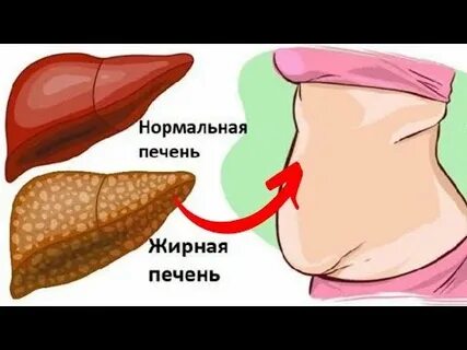 Жировая печень симптомы у женщин