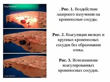 Коагуляция сосудов