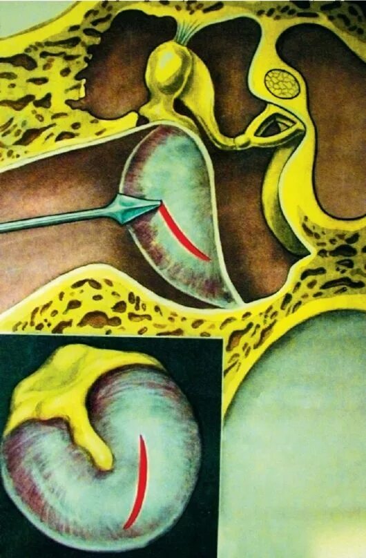 Показания для парацентеза при отите. Парацентез барабанной перепонки. Тимпанотомия барабанной перепонки. Парацентез при отите. Парацентез при отите.