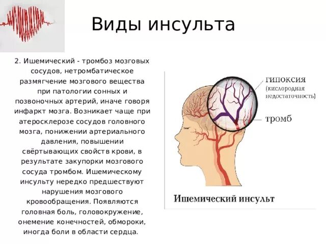 Инсульт левой артерии. Ишемический инсульт (инфаркт мозга). Инфаркт мозга вызванный тромбозом мозговых артерий. Артерии мозга при инсульте. Тромбоз носовых сосудов.