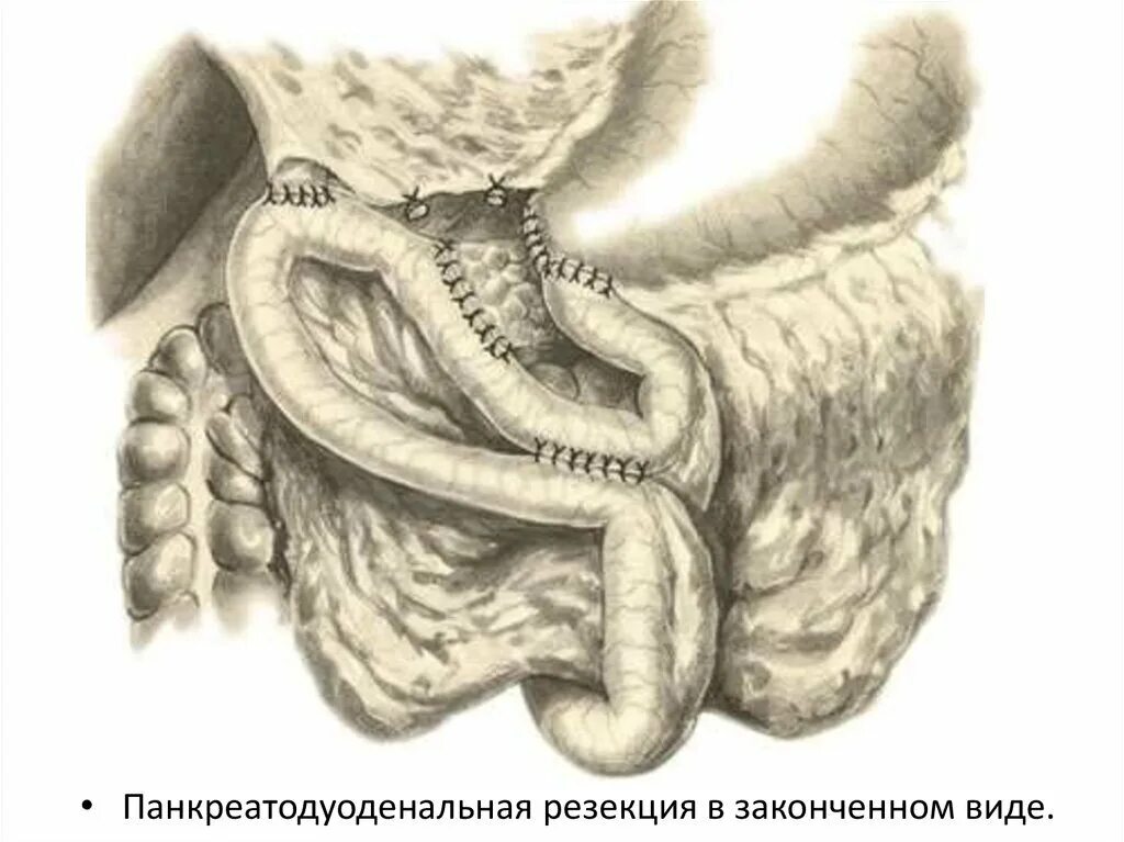 Панкреатодуоденальная резекция операция Whipple. Пилоросохраняющая панкреатодуоденальная резекция. Операция Уиппла (панкреатодуоденальная резекция). Панкреодуоденэктомия, панкреодуоденальная резекция.