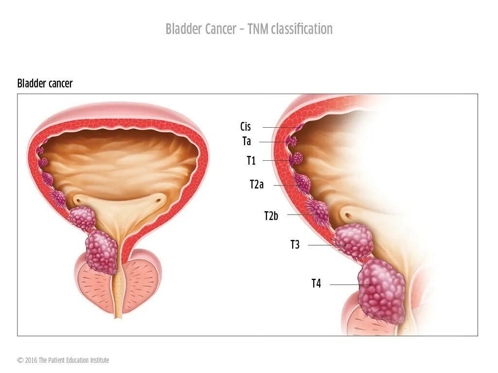 Опухоли мочевого пузыря классификация. Классификация опухоли мочевого пузыря TNM. Раковая опухоль мочевого пузыря.