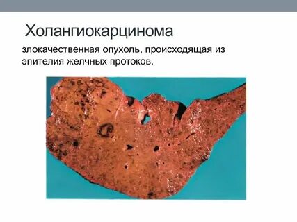 Вторичное злокачественное новообразование