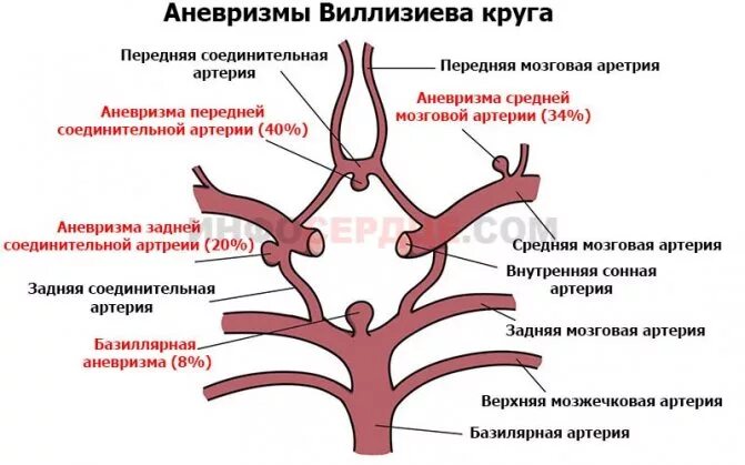 Развитие виллизиева круга в виде отсутствия кровотока