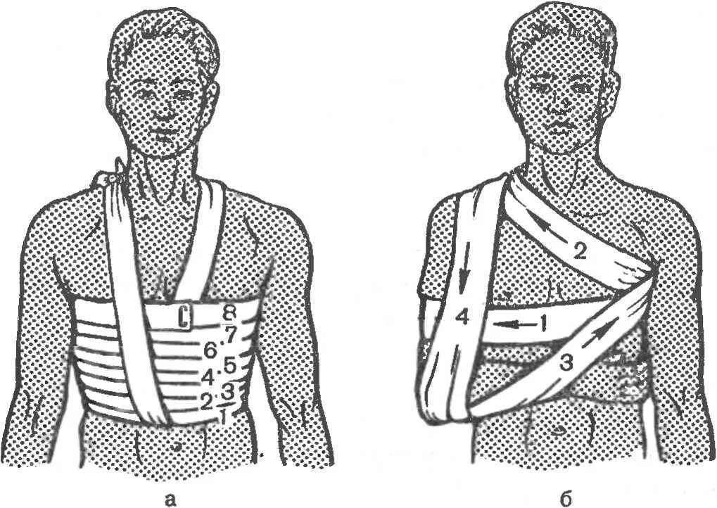 Первая медицинская помощь при переломе ребер. Повязка Дезо техника бинтами. Десмургия повязка Дезо. Десмургия повязки на грудную клетку. Повязка Дезо бинтом техника наложения.