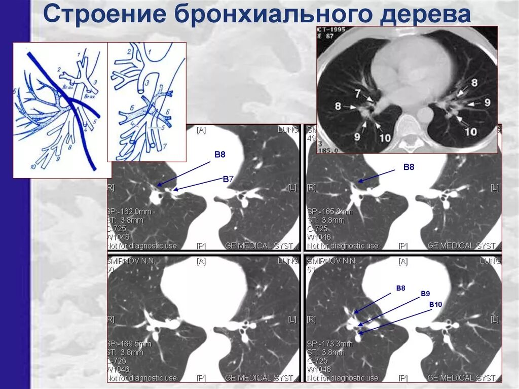 Бронх дерево строение. Сегментарные бронхи на кт. строение бронхиального дерева. строение бронхов на кт. анатомия бронхиального дерева на кт.