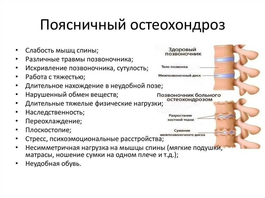 Как лечить спинной. Остеохондроз поясничного отдела периоды. Остеохондроз поясничном отделе позвоночника схема. Поясничный остеохондроз симптомы и лечение. Остеохондроз поясничного отдела симптомы.