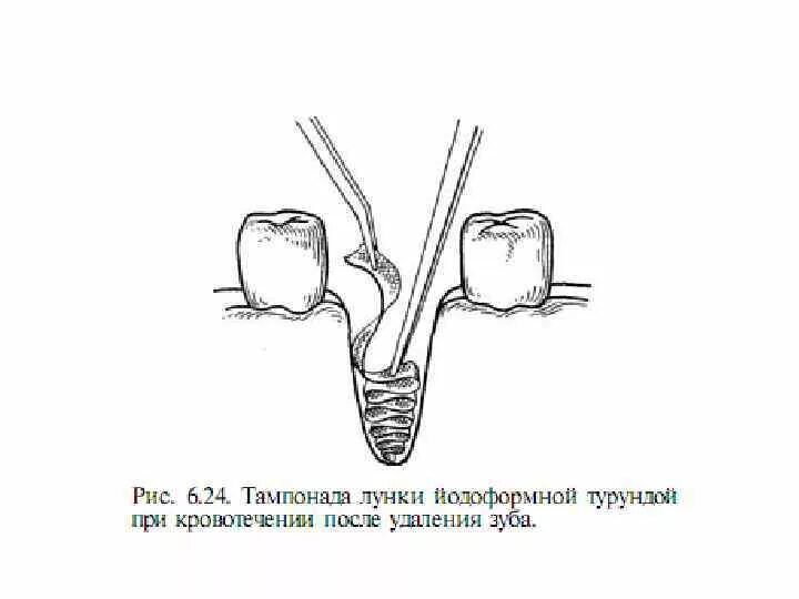 Остановить кровотечение удаления зуба. Турунда йодоформная в лунку зуба. Тампонада лунки зуба йодоформом. Тампонада йодоформной турундой. Тампонада лунки турундой.