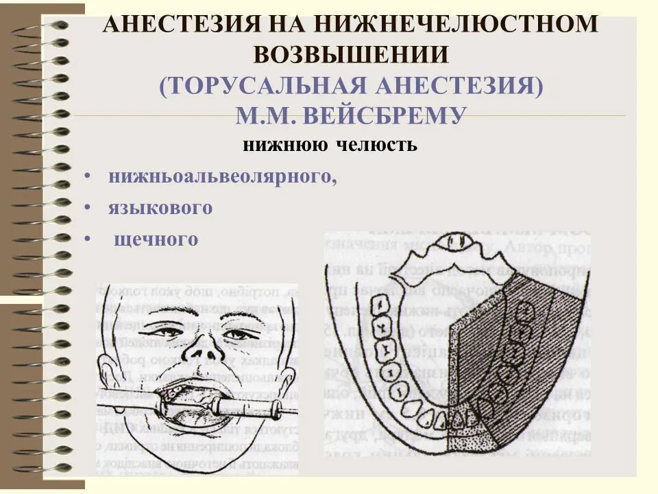 Анестезия по гейтсу. Торусальная анестезия нижней челюсти. Торусальная анестезия на нижней челюсти зоны обезболивания. Проводниковая анестезия нижней челюсти мандибулярная. Мандибулярная анестезия нижней челюсти.