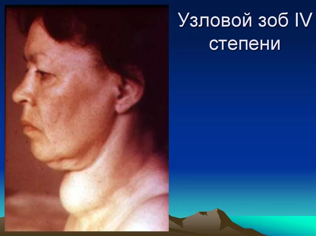 Одноузловой зоб щитовидной железы. Узловой эндемический зоб. Многоузловой эутиреоидный зоб щитовидной железы.