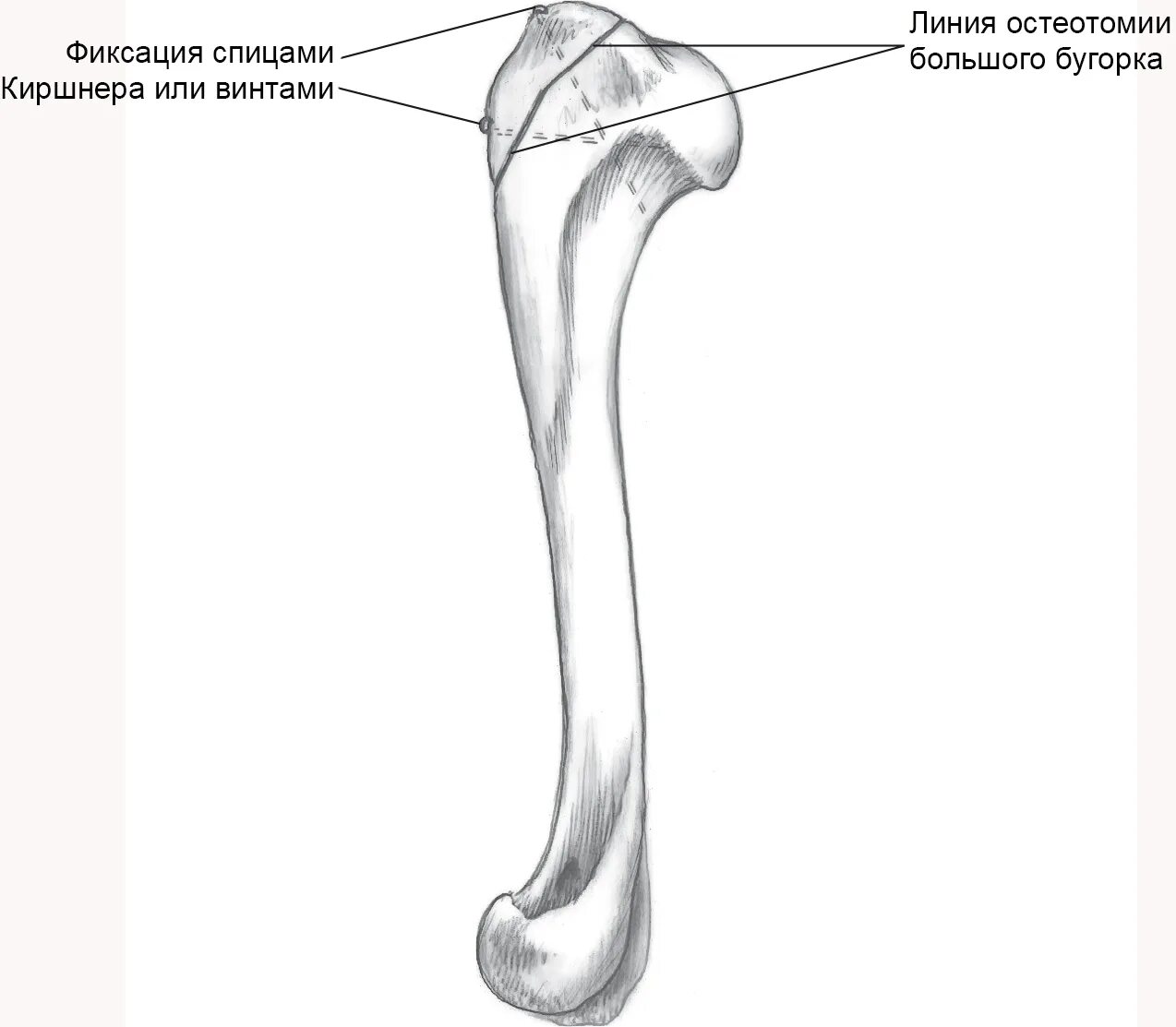 Перелом большого бугра плечевой кости без смещения рентген. Плечевая кость бугорок плечевой. Плечевая кость малый бугорок. Плечевой сустав анатомия бугорки. Бугорок кость.