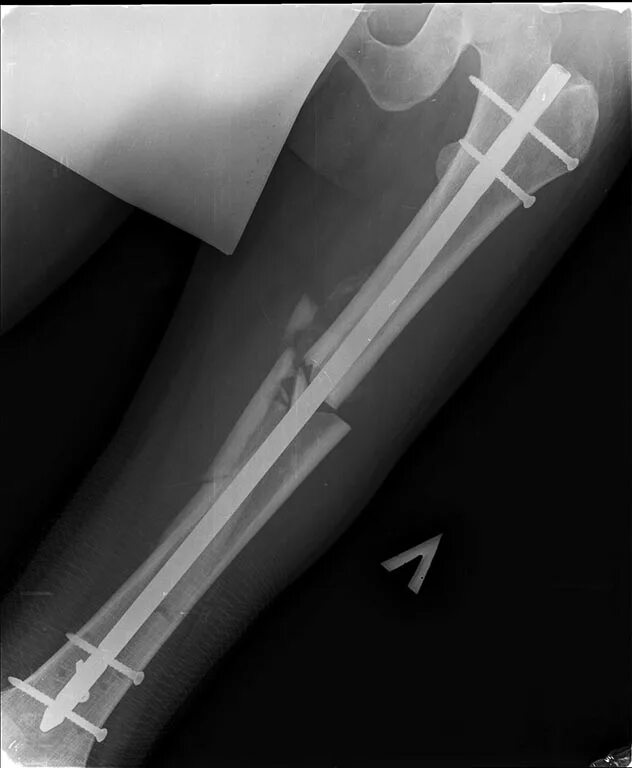 остеосинтез интрамедуллярный ветеринария. бедренная кость внутри. перелом шейки бедра остеосинтез. интрамедуллярный штифт бедренной кости. остеосинтез бедренной кости у кошки.