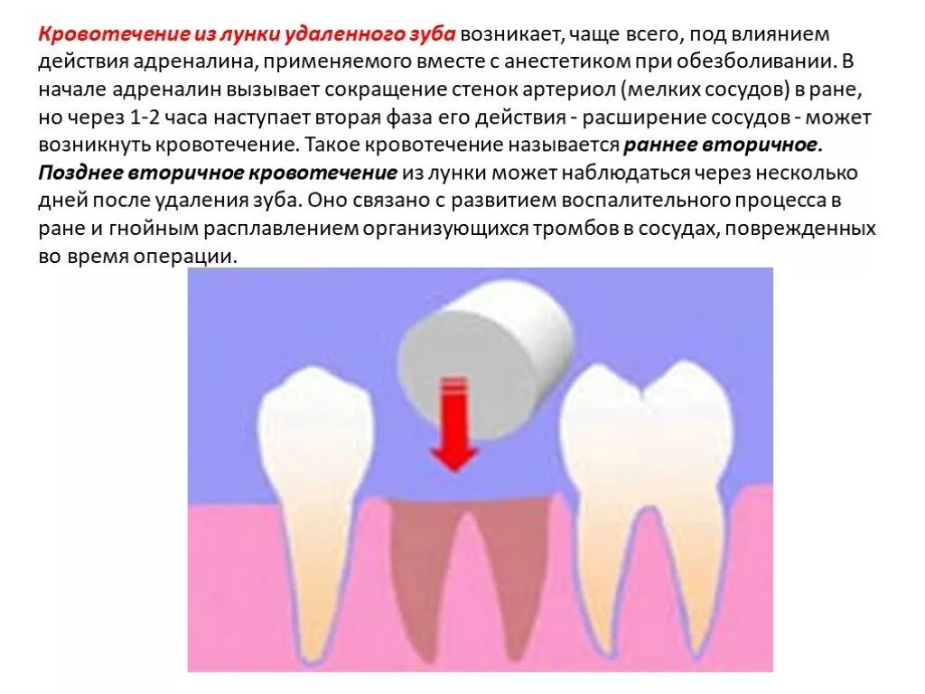 Остановить кровотечение удаления зуба. Кровотечение из лунки зуба. Кровотечение из лунки удаленного зуба. Кровотечение после экстракции зуба.