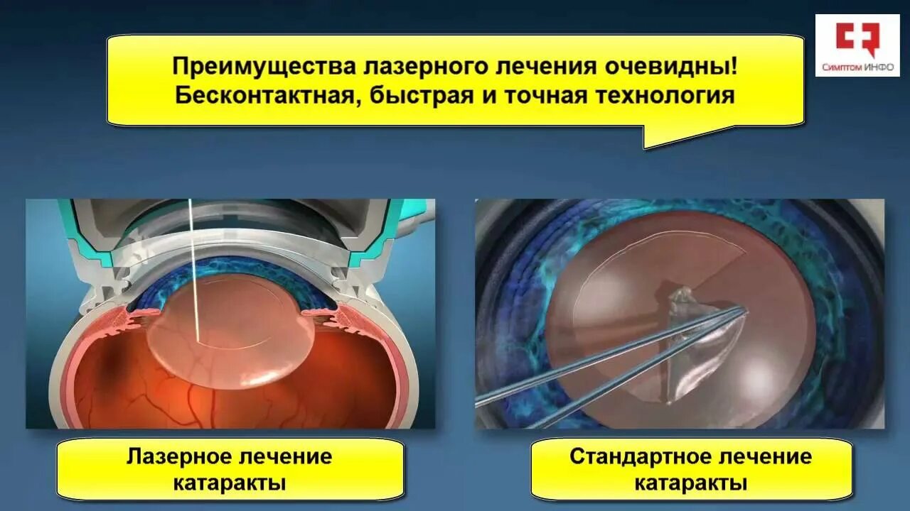 Факоэмульсификация катаракты лазером. Лазерная экстракция катаракты лазер. Экстракция катаракты операция.