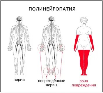 Полинейропатия видео