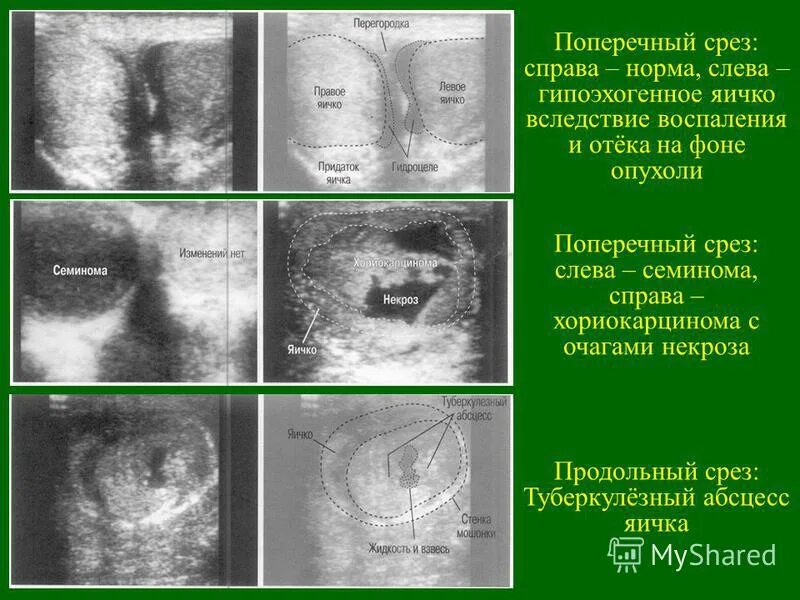 Объем яичка по УЗИ. Объем яичек в норме по УЗИ. Размеры придатка яичка в норме. Нормальная яичка мужчин