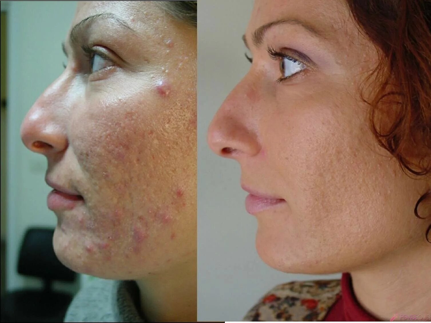 прыщи после ретинола. использования ретинола для лица до и после. 025. атрофические рубцы постакне. прыщи после ретинола.