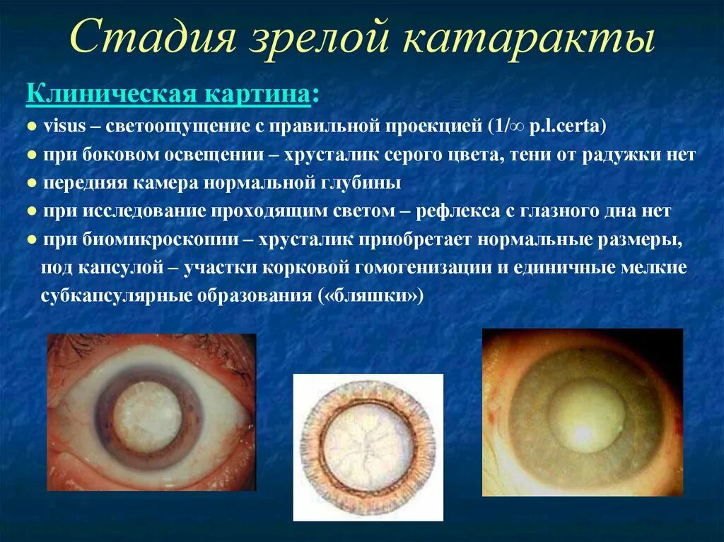 Какие стадии катаракты