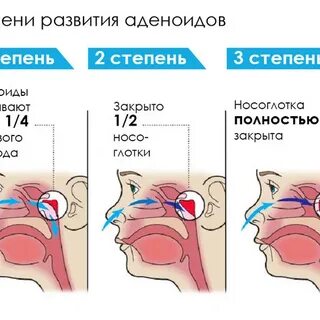 Какие признаки аденоидов