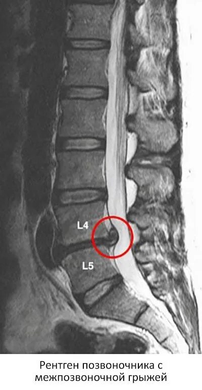 Грыжа поясничного отдела рентген. Позвоночная грыжа поясничного отдела рентген. Рентген l4-l5 диски.