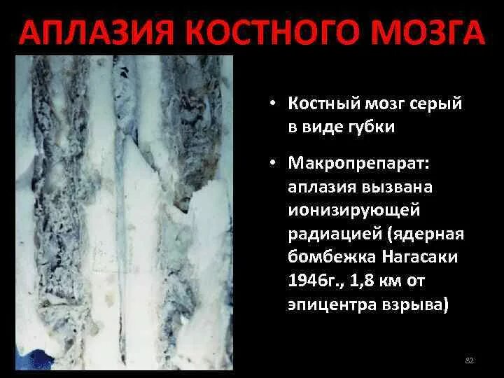 Трабекулярный отёк костного мозга l5/s1. Функция костного мозга в кости. Костномозговая форма лучевой болезни. Острый лейкоз костного мозга симптомы. Трансплантация костного мозга.