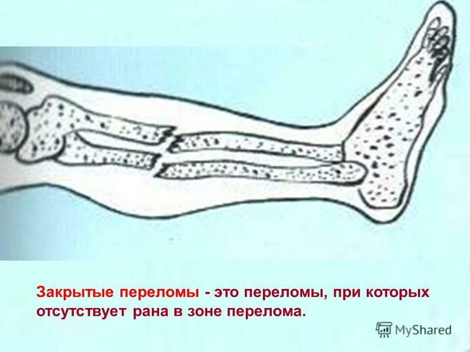 Степени открытого перелома