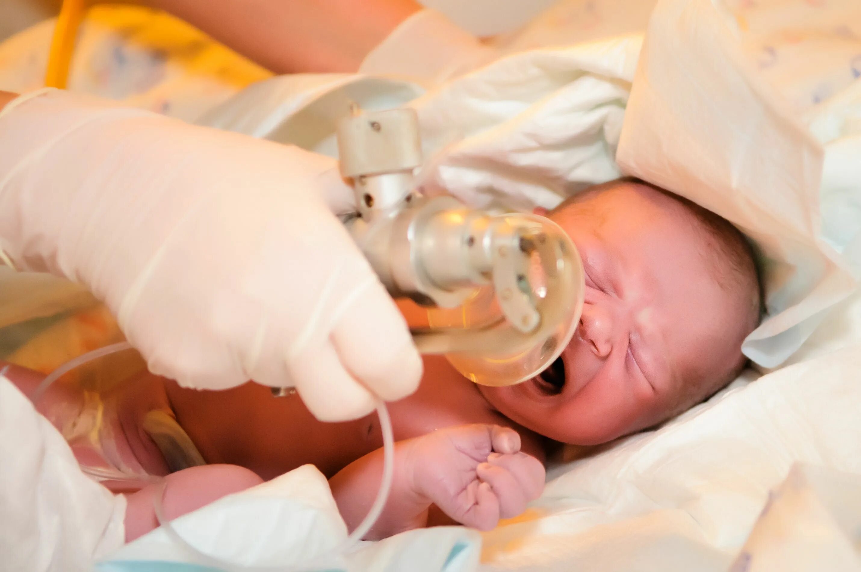 Асфиксия новорожденных. Оксигено терапия новорожд. Оксигенотерапия новорожденных. Асасфиксия у новорожденного.