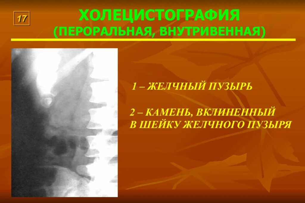 Пероральная холецистография. Холецистография желчного пузыря. Внутривенная пероральная холецистография. Холлецистаграфия ппрорадьная. Внутривенно холицестография..