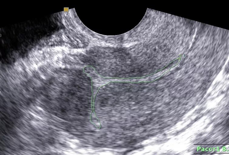 Полость матки деформирована. Несостоятельный рубец на матке УЗИ. УЗИ состоятельности рубца на матке. Метропластика несостоятельного рубца на матке. УЗИ несостоятельность рубца на матке.