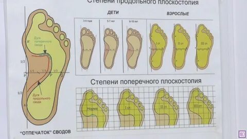 Что означает плоскостопие москва