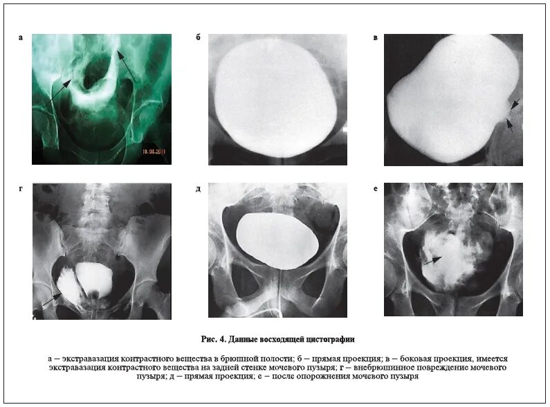 Нейрогенный мочевой пузырь цистография. Цистография мочевого пузыря рентген. Нейрогенный мочевой пузырь кт. Классификацию разрывов мочевого пузыря.